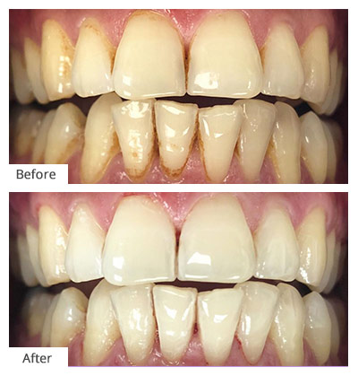 How Long Does A Deep Cleaning Take?