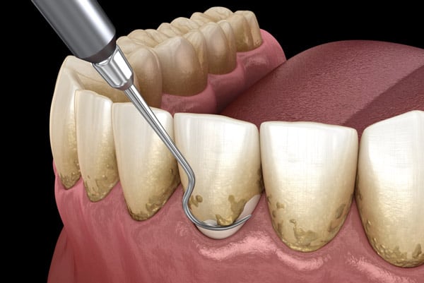 How Painful Is Deep Cleaning?